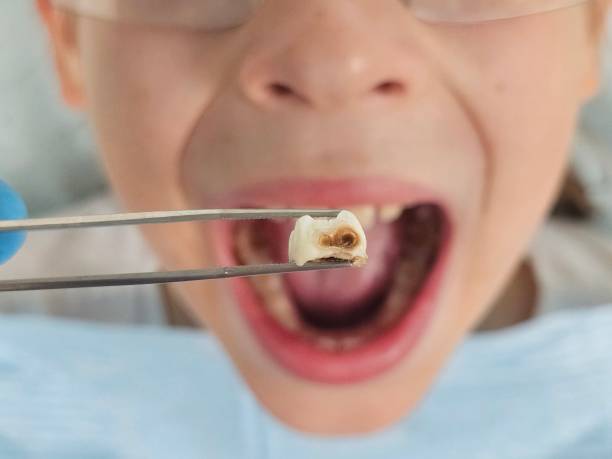 Best Emergency Treatment for Oral Infections in Charenton, LA